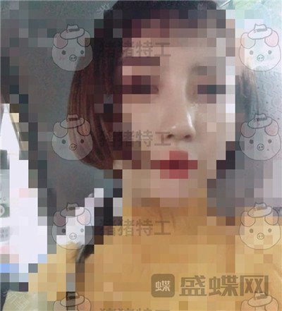 上海九院张盈帆鼻修复案例价格分享,平面模特小姐姐的鼻修复之路~