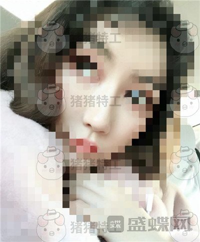 上海九院张盈帆鼻修复案例价格分享,平面模特小姐姐的鼻修复之路~