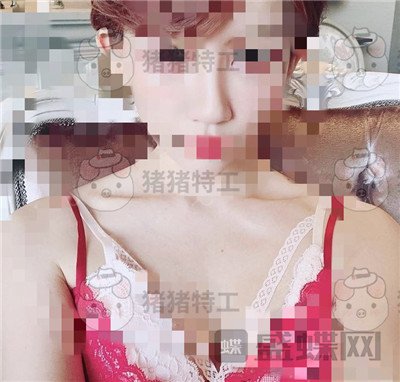 上海九院张盈帆鼻修复案例价格分享,平面模特小姐姐的鼻修复之路~