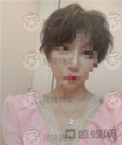 上海九院张盈帆鼻修复案例价格分享,平面模特小姐姐的鼻修复之路~