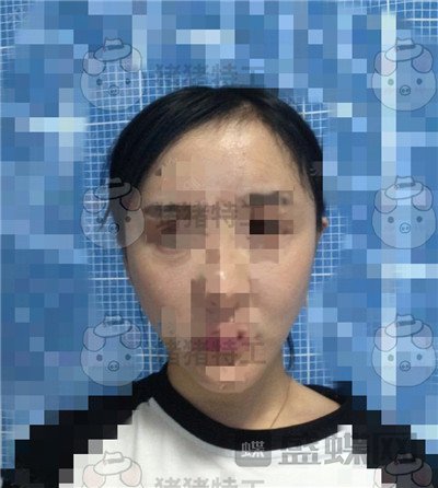 北京八大处解芳下巴截骨案例价格分享,之前被嘲笑蛇精脸终于有救了~