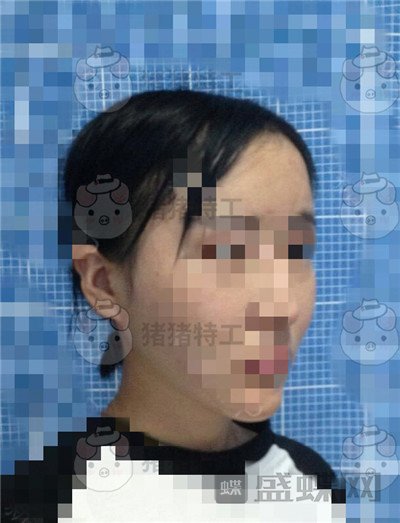 北京八大处解芳下巴截骨案例价格分享,之前被嘲笑蛇精脸终于有救了~