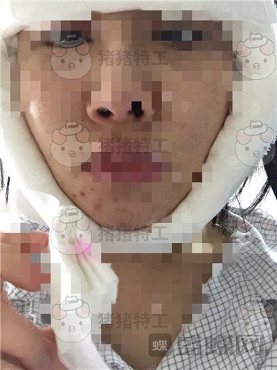 北京八大处解芳下巴截骨案例价格分享,之前被嘲笑蛇精脸终于有救了~