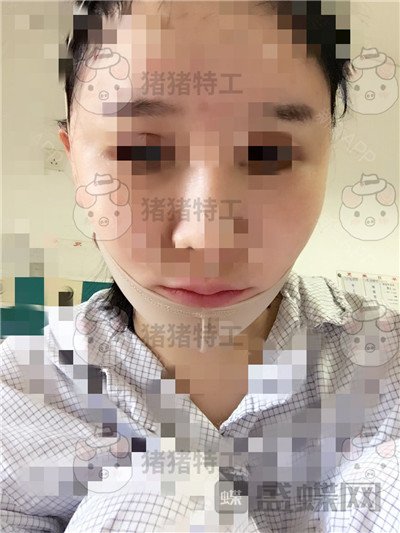 北京八大处解芳下巴截骨案例价格分享,之前被嘲笑蛇精脸终于有救了~
