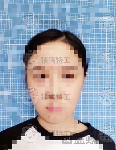 北京八大处解芳下巴截骨案例价格分享,之前被嘲笑蛇精脸终于有救了~
