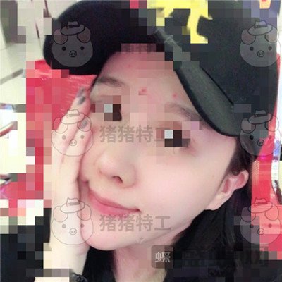 北京八大处解芳下巴截骨案例价格分享,之前被嘲笑蛇精脸终于有救了~