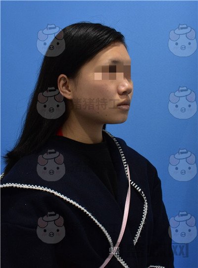 重庆万家燕王珍祥颧骨内推案例价格分享,瞬间变身十八岁美少女~