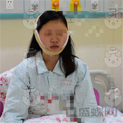 重庆万家燕王珍祥颧骨内推案例价格分享,瞬间变身十八岁美少女~