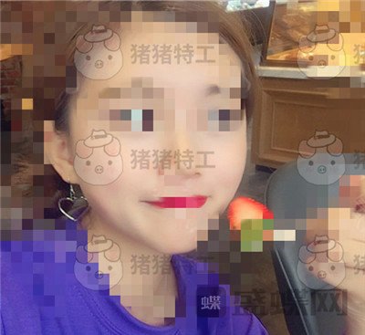 重庆万家燕王珍祥颧骨内推案例价格分享,瞬间变身十八岁美少女~