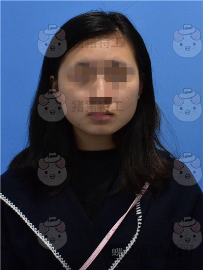 重庆万家燕王珍祥颧骨内推案例价格分享,瞬间变身十八岁美少女~