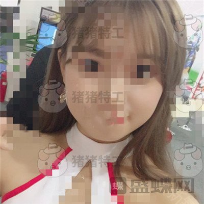 重庆万家燕王珍祥颧骨内推案例价格分享,瞬间变身十八岁美少女~