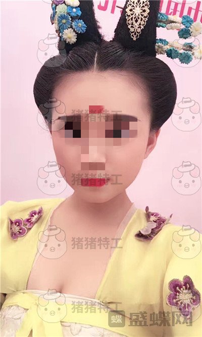 重庆万家燕王珍祥颧骨内推案例价格分享,瞬间变身十八岁美少女~