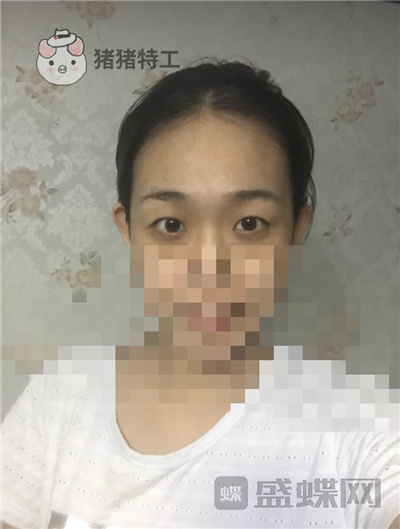 杭州美莱韩超双眼皮案例价格分享,做个双眼皮朋友以为我去换了个头??