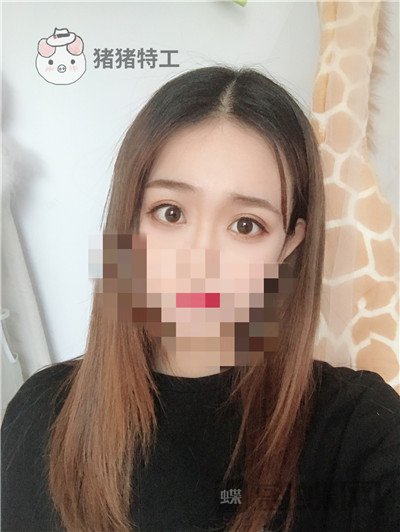 杭州美莱韩超双眼皮案例价格分享,做个双眼皮朋友以为我去换了个头??