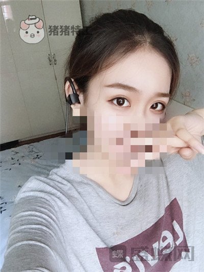 杭州美莱韩超双眼皮案例价格分享,做个双眼皮朋友以为我去换了个头??