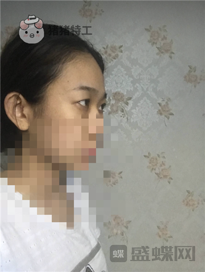 杭州美莱韩超双眼皮案例价格分享,做个双眼皮朋友以为我去换了个头??