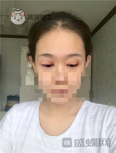 杭州美莱韩超双眼皮案例价格分享,做个双眼皮朋友以为我去换了个头??