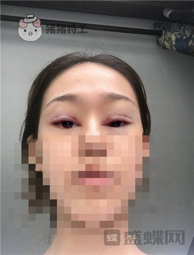 杭州美莱韩超双眼皮案例价格分享,做个双眼皮朋友以为我去换了个头??