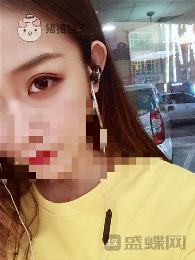 杭州美莱韩超双眼皮案例价格分享,做个双眼皮朋友以为我去换了个头??