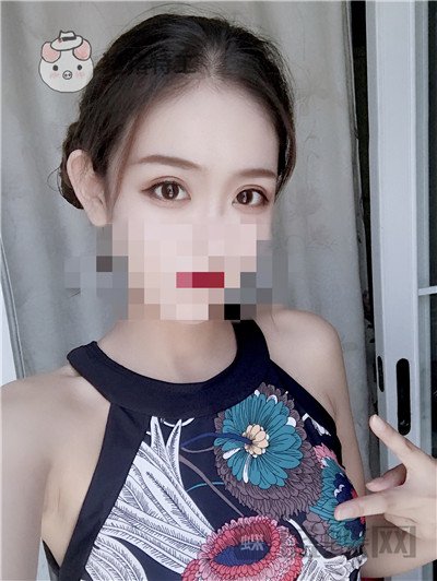 杭州美莱韩超双眼皮案例价格分享,做个双眼皮朋友以为我去换了个头??