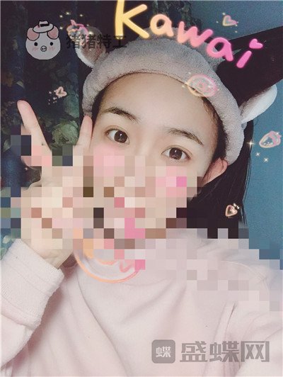 杭州美莱韩超双眼皮案例价格分享,做个双眼皮朋友以为我去换了个头??