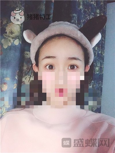 杭州美莱韩超双眼皮案例价格分享,做个双眼皮朋友以为我去换了个头??