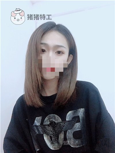 杭州美莱韩超双眼皮案例价格分享,做个双眼皮朋友以为我去换了个头??