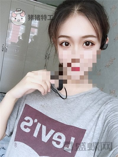 杭州美莱韩超双眼皮案例价格分享,做个双眼皮朋友以为我去换了个头??