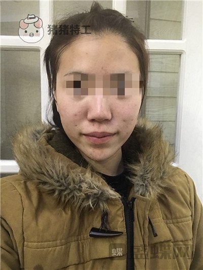 北京润美玉之光王明利面部填充案例价格分享,现在的脸让我自信心爆棚~