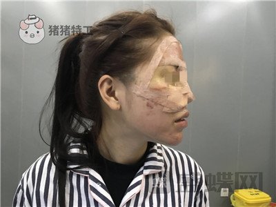 北京润美玉之光王明利面部填充案例价格分享,现在的脸让我自信心爆棚~