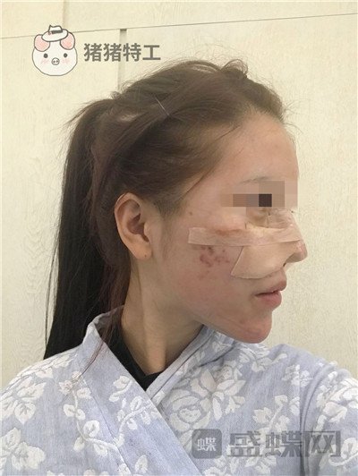 北京润美玉之光王明利面部填充案例价格分享,现在的脸让我自信心爆棚~