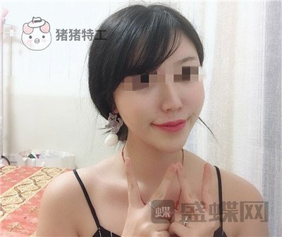 北京润美玉之光王明利面部填充案例价格分享,现在的脸让我自信心爆棚~