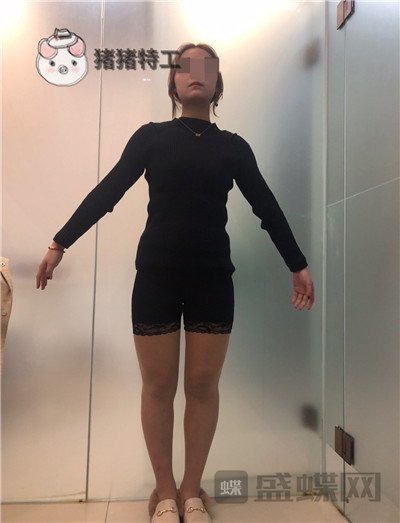 昆明梦想整形李成龙吸脂案例价格分享,小象腿到筷子腿的完美蜕变~