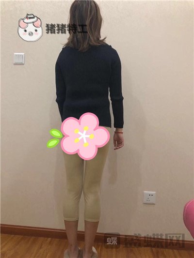 昆明梦想整形李成龙吸脂案例价格分享,小象腿到筷子腿的完美蜕变~