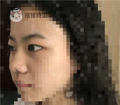 上海百达丽周珍艳双眼皮鼻部手术案例价格分享,我终于也变成了女神!