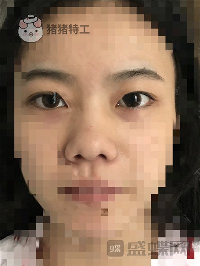 上海百达丽周珍艳双眼皮鼻部手术案例价格分享,我终于也变成了女神!