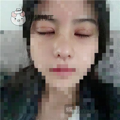 上海百达丽周珍艳双眼皮鼻部手术案例价格分享,我终于也变成了女神!
