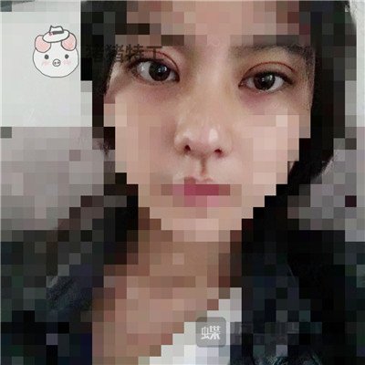上海百达丽周珍艳双眼皮鼻部手术案例价格分享,我终于也变成了女神!