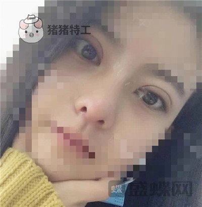 上海百达丽周珍艳双眼皮鼻部手术案例价格分享,我终于也变成了女神!