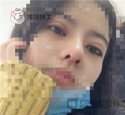 上海百达丽周珍艳双眼皮鼻部手术案例价格分享,我终于也变成了女神!
