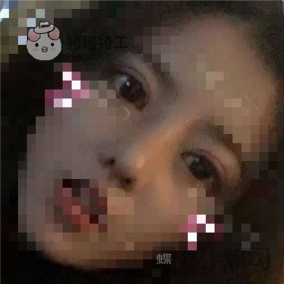 上海百达丽周珍艳双眼皮鼻部手术案例价格分享,我终于也变成了女神!