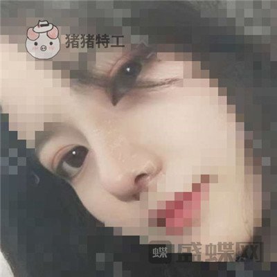 上海百达丽周珍艳双眼皮鼻部手术案例价格分享,我终于也变成了女神!