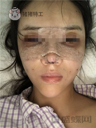 上海华美李健面部填充案例价格分享,开始脸肿的样子以为整失败了。
