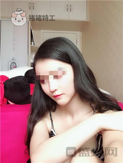 上海华美李健面部填充案例价格分享,开始脸肿的样子以为整失败了。