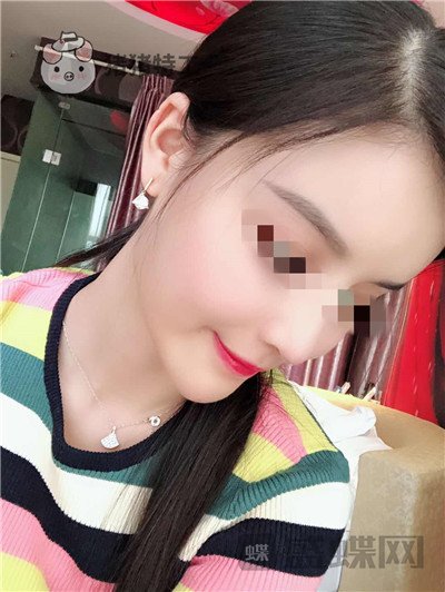 上海华美李健面部填充案例价格分享,开始脸肿的样子以为整失败了。
