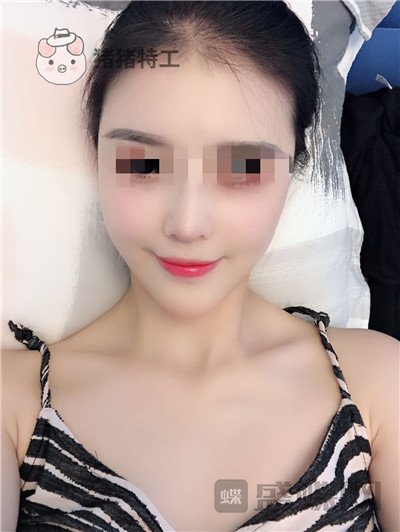 上海华美李健面部填充案例价格分享,开始脸肿的样子以为整失败了。
