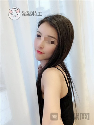 上海华美李健面部填充案例价格分享,开始脸肿的样子以为整失败了。