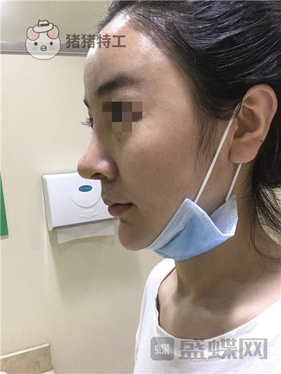 上海华美李庭勋隆鼻案例价格分享,这张混血脸你招架得住吗?