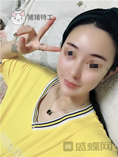 上海华美李庭勋隆鼻案例价格分享,这张混血脸你招架得住吗?