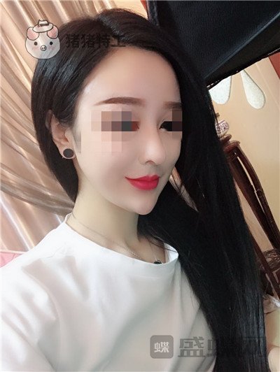 上海华美李庭勋隆鼻案例价格分享,这张混血脸你招架得住吗?